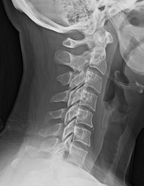 Who pays for my medical bills if I am injured in a car crash?